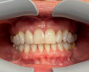 Retracted Frontal, In Occlusion Retracted Frontal, In Occlusion