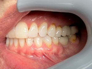 Retracted Left, In Occlusion Retracted Left, In Occlusion