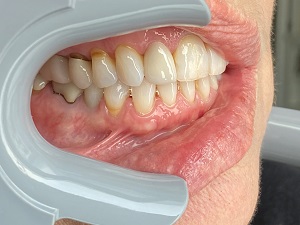 Retracted Right, In Occlusion Retracted Right, In Occlusion